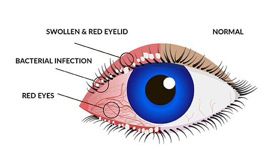 image of Blepharitis | Centers for dry eye